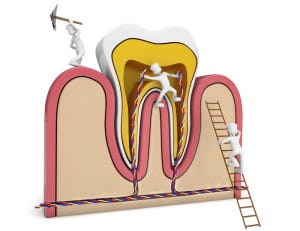 about root canals