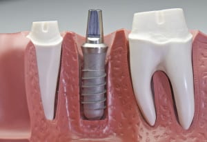 model for learning about dental implants