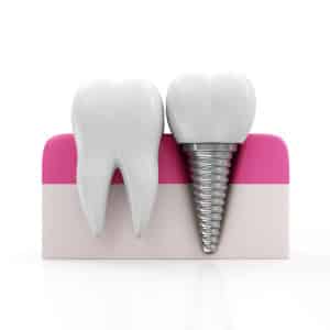 dentalimplantpink