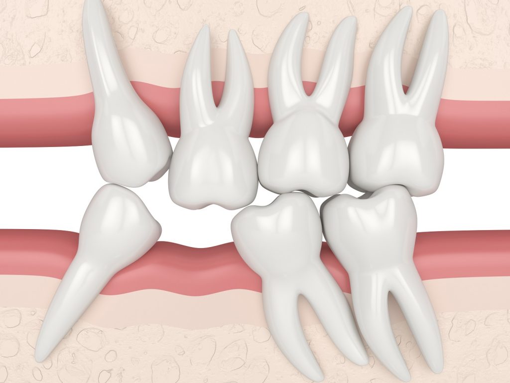 What Does Loss Of Teeth In A Dream Mean