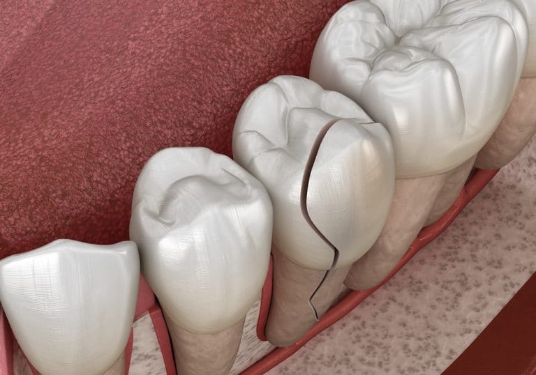 Why Fixing a Cracked Tooth Quickly Is Important Conroe, TX