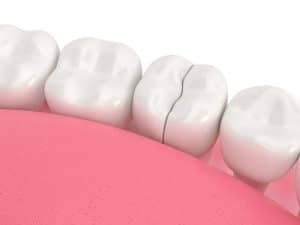 3d render of jaw with treatable cracked tooth over white background. Types of broken teeth concept.