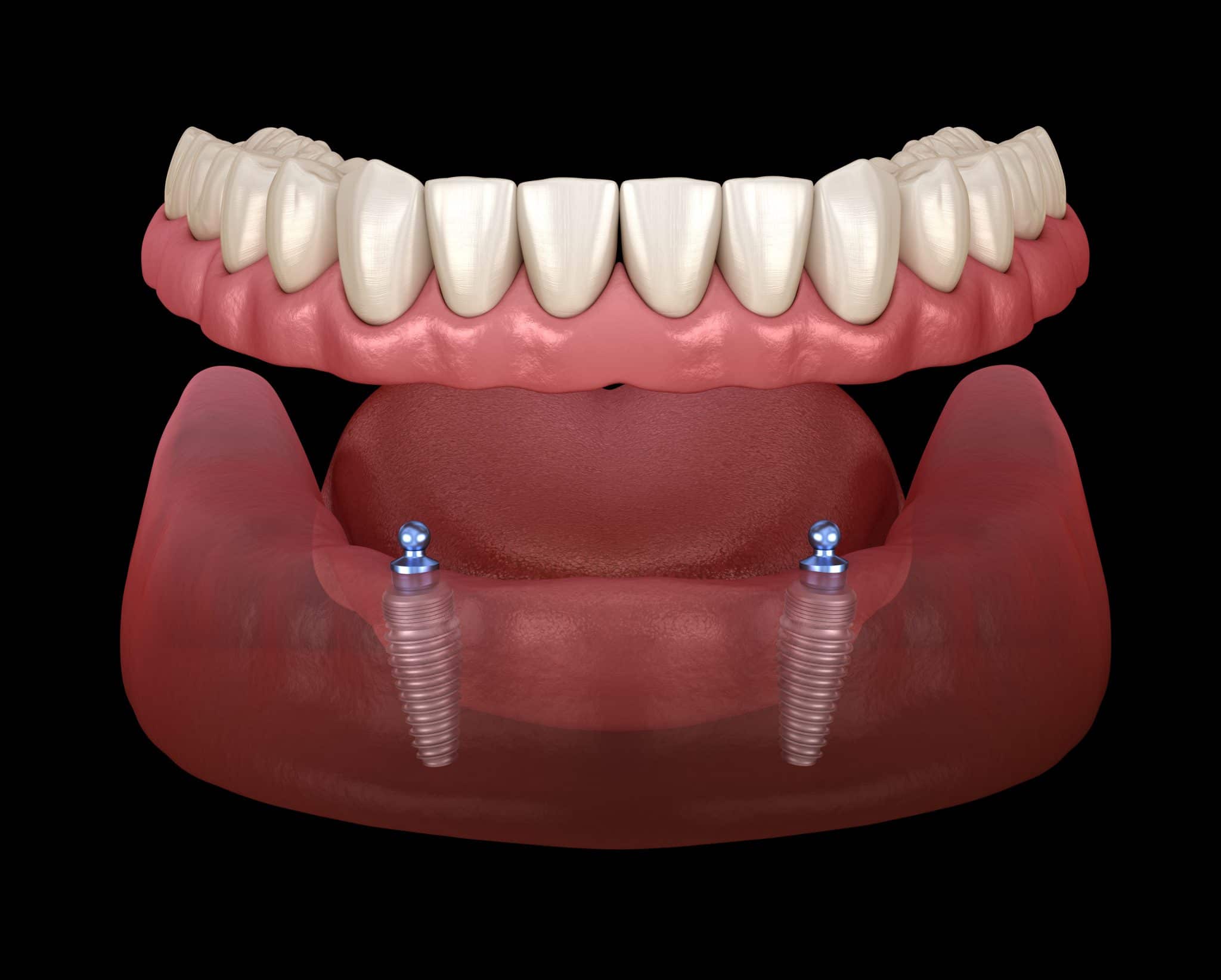 When to Consider a Dental Implant Conroe, TX