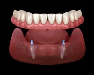 Mandibular removable prosthesis All on 2 system supported by implants with ball attachments. Medically accurate dental 3D illustration