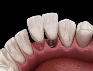 Maryland bridge implant based, frontal tooth recovery. Medically accurate 3D animation of dental concept