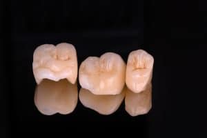 Dental Crowns Versus Dental Fillings