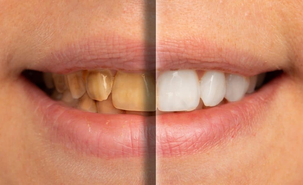 A close-up and split view on the mouth of a young Caucasian adult, before and after of cosmetic dentistry whitening procedure, where the teeth are bleached to remove stains.