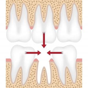 Teeth are moving to fill empty space from missing tooth.