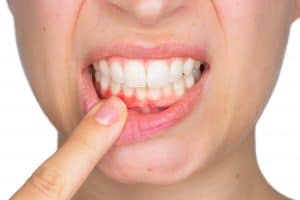 Closeup portrait of young woman showing with his finger inflamed lower gingiva with pain expression. Dental care and toothache.