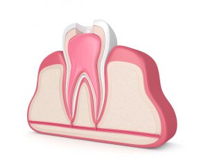 3d render of tooth in gums with root canal treatment procedure