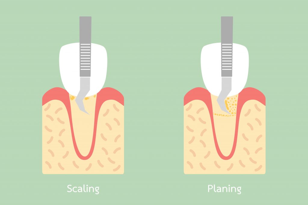 teeth scaling - dental plaque removal, anatomy structure including the bone and gum - tooth cartoon vector flat style cute character for design