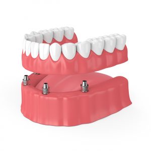 3d render of removable full implant denture isolated over white background