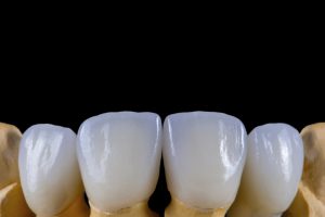 Ceramic teeth with the implant on a plaster model isolated on a black background.
