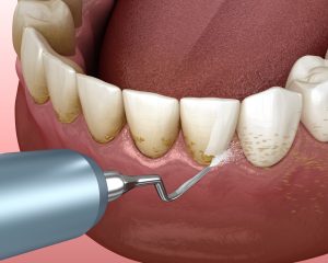 Oral hygiene: Scaling and root planing (conventional periodontal therapy). Medically accurate 3D illustration of human teeth treatment