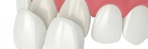 3d render of upper jaw with veneers over white