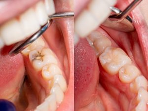 Dental caries. Filling with dental composite photopolymer material using Rubber Dam. The concept of dental treatment in a dental clinic