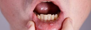 Tumor in the mouth, Mucocele lip, Stomatitis, herpes zoster, pemphigus