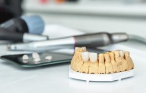 Artificial jaw with veneers and crowns, medical instrument. Making prostheses in a dental laboratory.