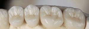 high quality ceramic Dental crowns, gum of the jaw
