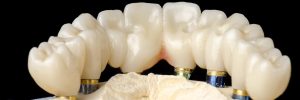 Monolithic zirconia restorations full arch implant supported with the ceramic load in vestibular, back background.
