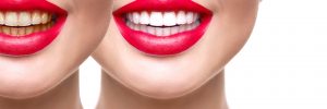 Woman teeth after whitening. Dental health concept