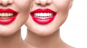 Woman teeth after whitening. Dental health concept