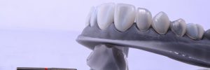 Close up of a dental model with veneers mounted on with dental tools isolated.
