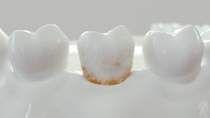 strong plaque on a molar tooth -- 3D Rendering