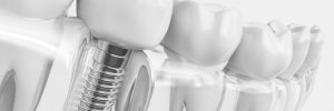 Tooth human implant. Dental concept. Human teeth or dentures. 3d rendering