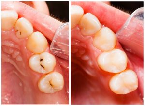 Teeth before and after treatment - dental composite filling.