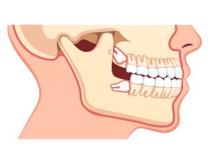 Human jaws model with teeth row. Impacted upper and lower wisdom tooth pushing adjacent teeth. Wisdom third molar tooth problem. Dentistry and dental surgery concept. Flat vector illustration on white
