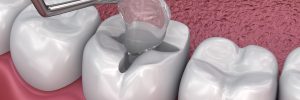 Dental fissure fillings, Medically accurate 3D illustration