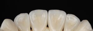 Ceramic veneers, lower central incisors