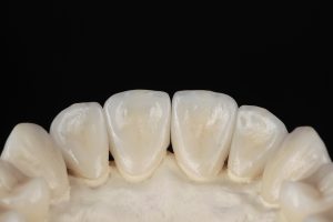 Ceramic veneers, lower central incisors