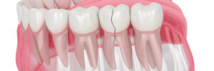 3d render of jaw with nontreatable cracked tooth over white background. Types of broken teeth concept.