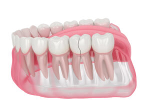 3d render of jaw with nontreatable cracked tooth over white background. Types of broken teeth concept.