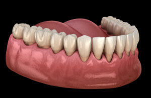 Gum recession process. Medically accurate 3D illustration