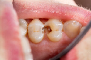 Dental caries. Filling with dental composite photopolymer material using Rubber Dam. The concept of dental treatment in a dental clinic