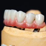 Spanning A Gap With A Dental Bridge