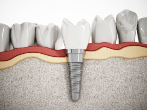 Illustration of teeth showing dental implant structure