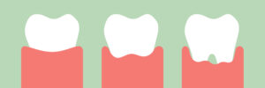 dental cartoon vector, step of gum disease - healthy teeth, gingivitis and periodontitis