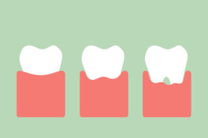 dental cartoon vector, step of gum disease - healthy teeth, gingivitis and periodontitis