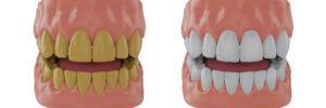 Jaw with yellow teeth, jaw with whitened teeth, Before and after whitening concept, 3d render