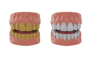 Jaw with yellow teeth, jaw with whitened teeth, Before and after whitening concept, 3d render