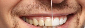 Smiling man before and after teeth whitening procedure, closeup