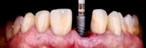 inserting the dental implant