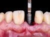 Understanding Your Implant Treatment