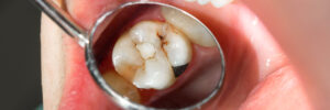close-up of a human rotten carious tooth at the treatment stage in a dental clinic. The use of rubber dam system with latex scarves and metal clips, production of photopolymeric composite fillings