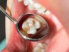 What A Filling Does For Your Smile