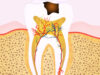 Treating Infected Teeth Roots